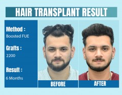 Top Celebrity Hair Transplant Doctor in Delhi, India: Evidence-Based Hair Restoration for Public Figures